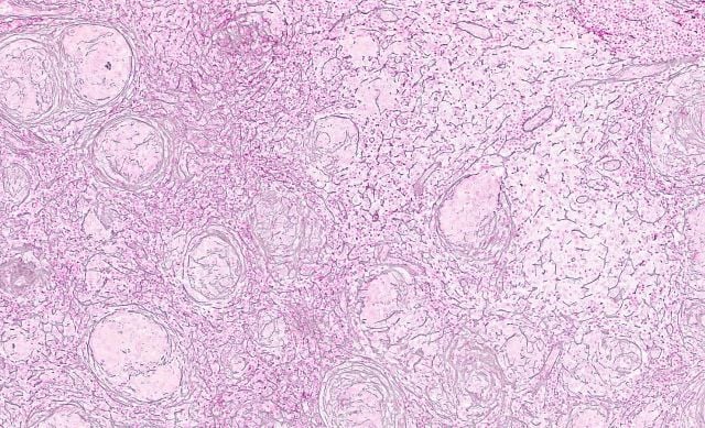 99. Reticulin Pathomics