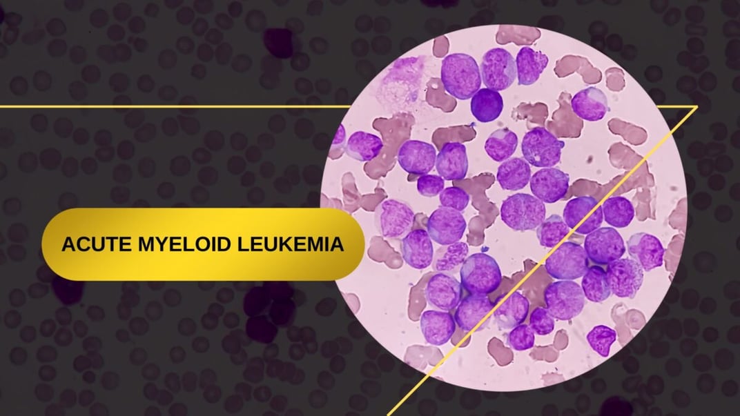 Clinical Trial Trends: Acute Myeloid Leukemia (AML)
